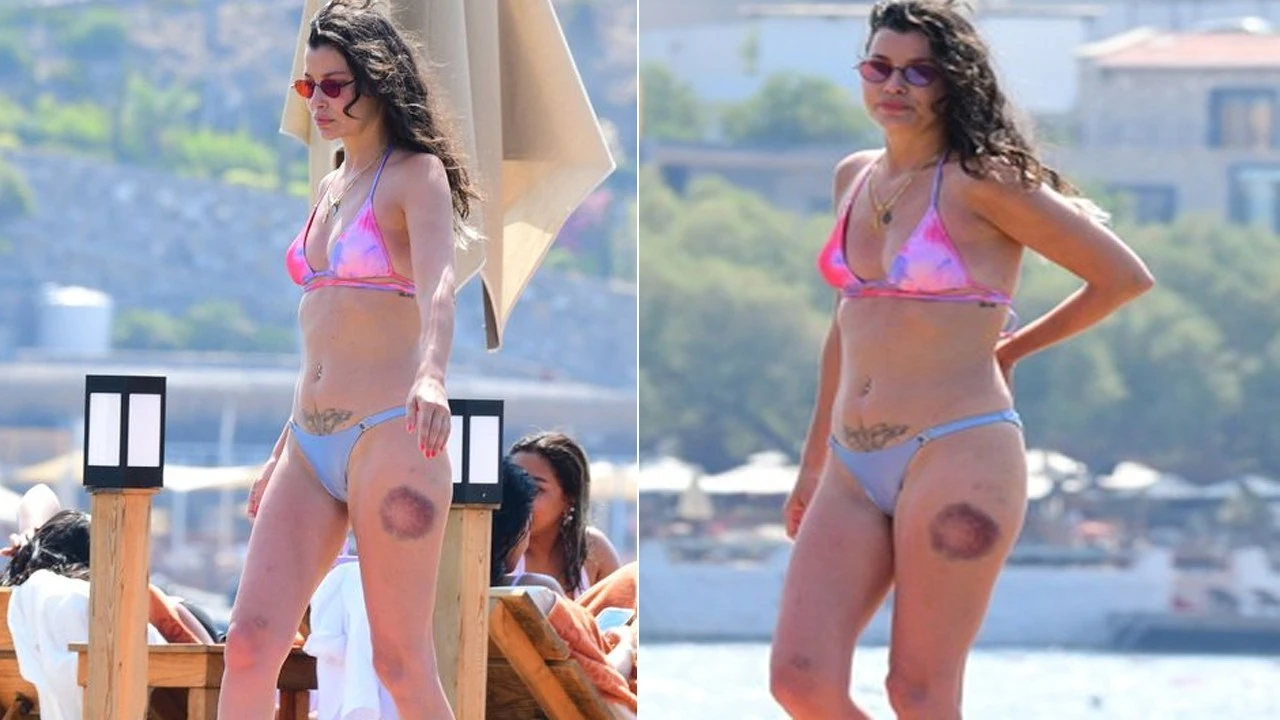 Müjde Uzman'ın bacaklarındaki morluklar endişelendirdi