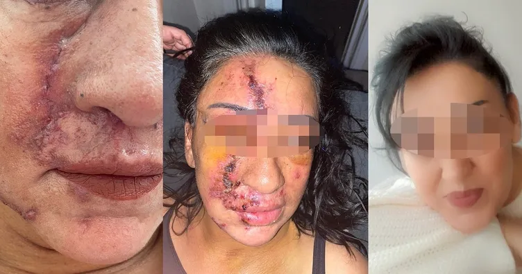 Konya’da Estetik Kabusu: 53 Yaşındaki Kadın Ölümden Döndü