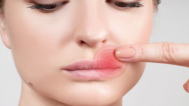 Dudağınızda çıkan uçuğu yok edecek doğal karışım! Günde 4 kez sürün sonucu görün