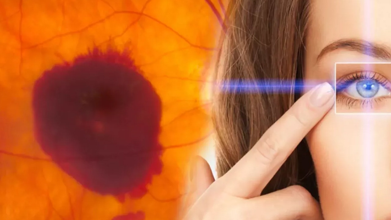 Sarı nokta hastalığı için en faydalı besinler